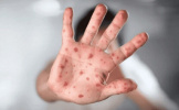 تاثیر ۸۵ درصدی واکسیناسیون علیه آبله در پیشگیری از آبله میمون (Monkeypox)