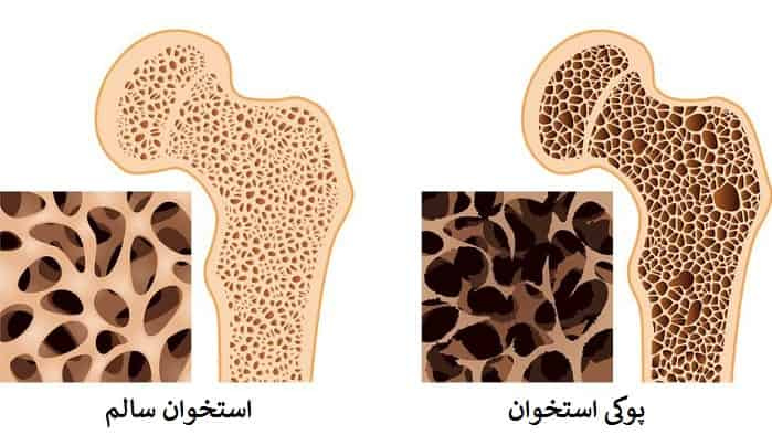 پوکی استخوان بیماری خاموش